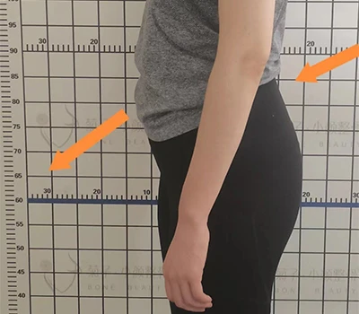 Užpakalinio dubens pakreipimo įvertinimas: klinikinė įžvalga, komercinė vertė ir korekcinės priem...