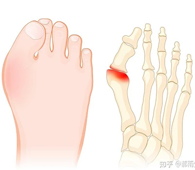 Hallux Valgus: Išsamus mokslo vadovas