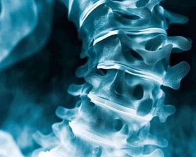 AI skoliozės atranka ir stuburo išlyginimo stebėjimas: pažangesnis 3D sveikatos patikrinimo spren...