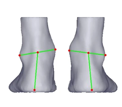 Heel Valgus ir Varus: tyli grėsmė skersai