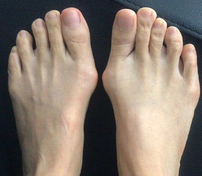 „Hallux Valgus“ matavimas: kodėl 3D skaitytuvai viršija klinikų gydytojus ir ligonines