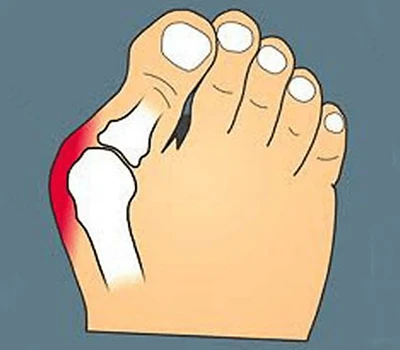 „Bunion Care“ transformacija: tikslaus nuskaitymo integravimas, siekiant geresnio pritaikymo, pac...